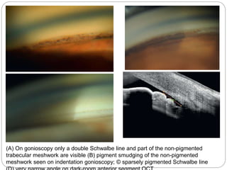 (A) On gonioscopy only a double Schwalbe line and part of the non-pigmented
trabecular meshwork are visible (B) pigment smudging of the non-pigmented
meshwork seen on indentation gonioscopy; © sparsely pigmented Schwalbe line
 