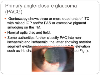 Primary angle-closure glaucoma
(PACG)
 Gonioscopy shows three or more quadrants of ITC
with raised IOP and/or PAS or excessive pigment
smudging on the TM.
 Normal optic disc and field.
 Some authorities further classify PAC into non-
ischaemic and ischaemic, the latter showing anterior
segment evidence of prior substantial IOP elevation
such as iris changes or glaukomflecken (see Fig. ).
 