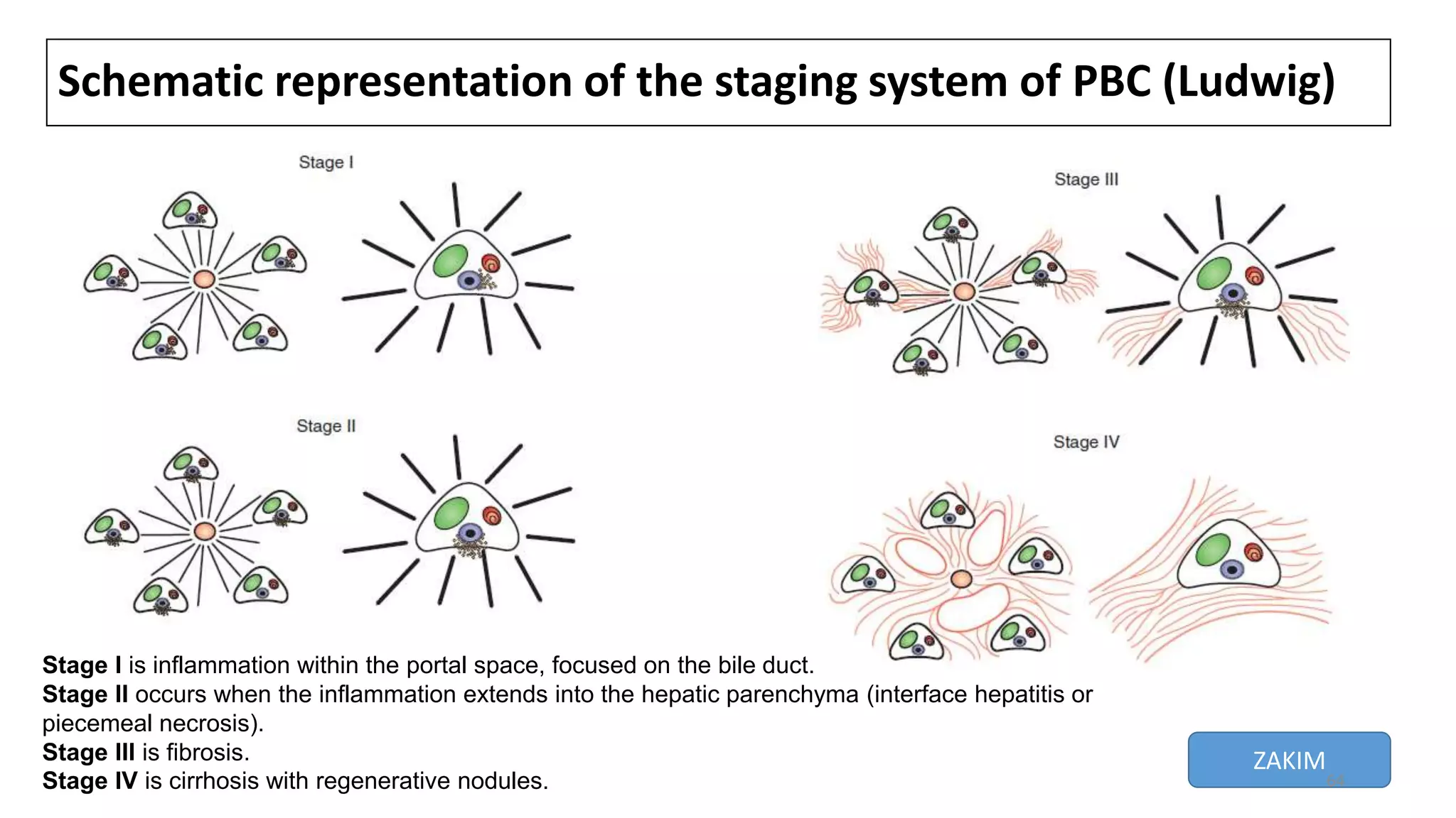 Schematic representation of the staging system of PBC (Ludwig)
Stage I is inflammation within the portal space, focused on the bile duct.
Stage II occurs when the inflammation extends into the hepatic parenchyma (interface hepatitis or
piecemeal necrosis).
Stage III is fibrosis.
Stage IV is cirrhosis with regenerative nodules.
ZAKIM
64
 