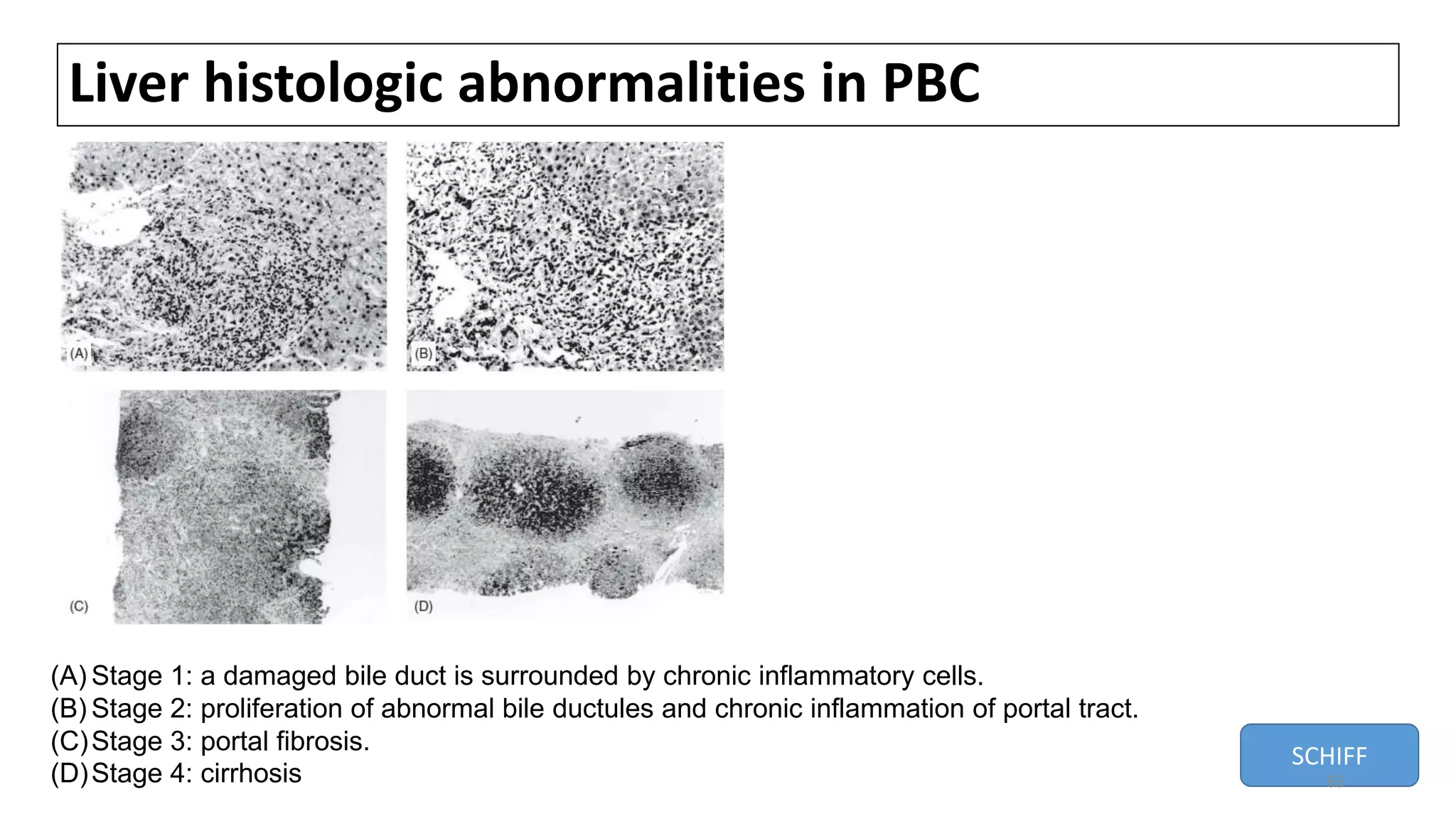 Liver histologic abnormalities in PBC
(A) Stage 1: a damaged bile duct is surrounded by chronic inflammatory cells.
(B) Stage 2: proliferation of abnormal bile ductules and chronic inflammation of portal tract.
(C)Stage 3: portal fibrosis.
(D)Stage 4: cirrhosis
SCHIFF
65
 