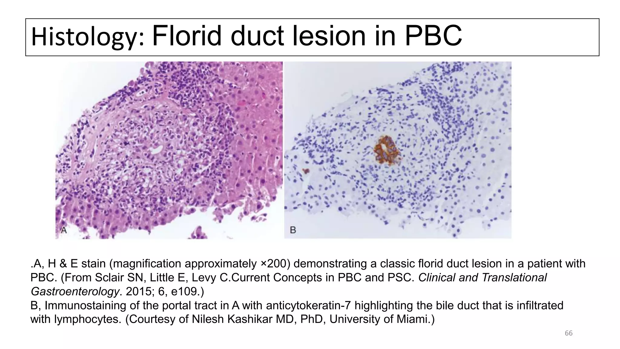 Histology: Florid duct lesion in PBC
.A, H & E stain (magnification approximately ×200) demonstrating a classic florid duct lesion in a patient with
PBC. (From Sclair SN, Little E, Levy C.Current Concepts in PBC and PSC. Clinical and Translational
Gastroenterology. 2015; 6, e109.)
B, Immunostaining of the portal tract in A with anticytokeratin-7 highlighting the bile duct that is infiltrated
with lymphocytes. (Courtesy of Nilesh Kashikar MD, PhD, University of Miami.)
66
 