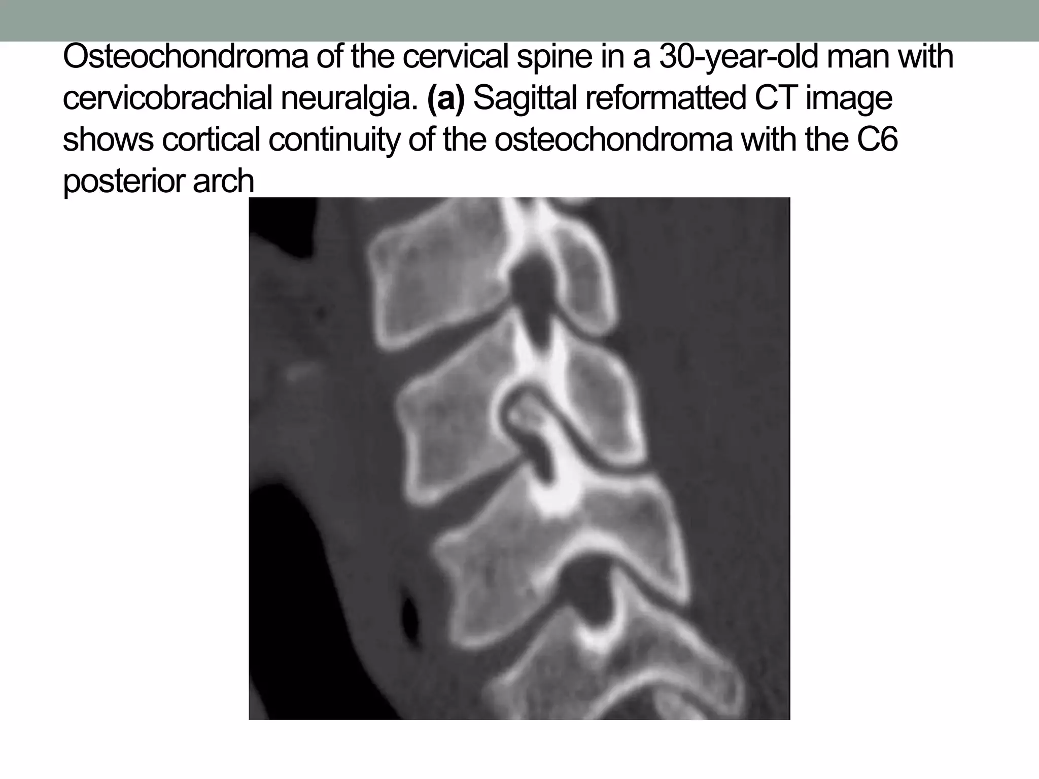 Osteochondroma of the cervical spine in a 30-year-old man with
cervicobrachial neuralgia. (a) Sagittal reformatted CT image
shows cortical continuity of the osteochondroma with the C6
posterior arch
 