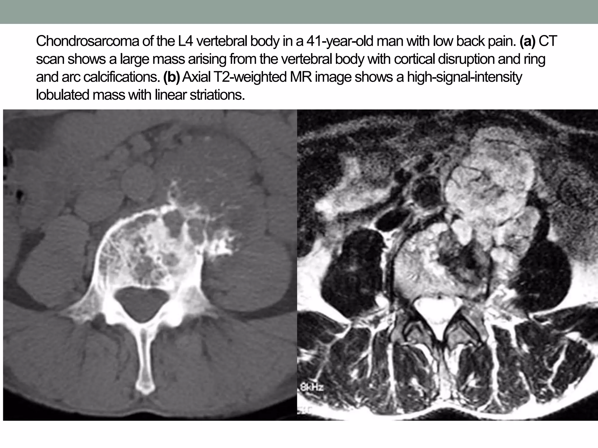 Chondrosarcoma of the L4 vertebral body in a 41-year-old man with low back pain. (a) CT
scan shows a large mass arising from the vertebral body with cortical disruption and ring
and arc calcifications.(b)Axial T2-weighted MR image shows a high-signal-intensity
lobulated mass with linear striations.
 