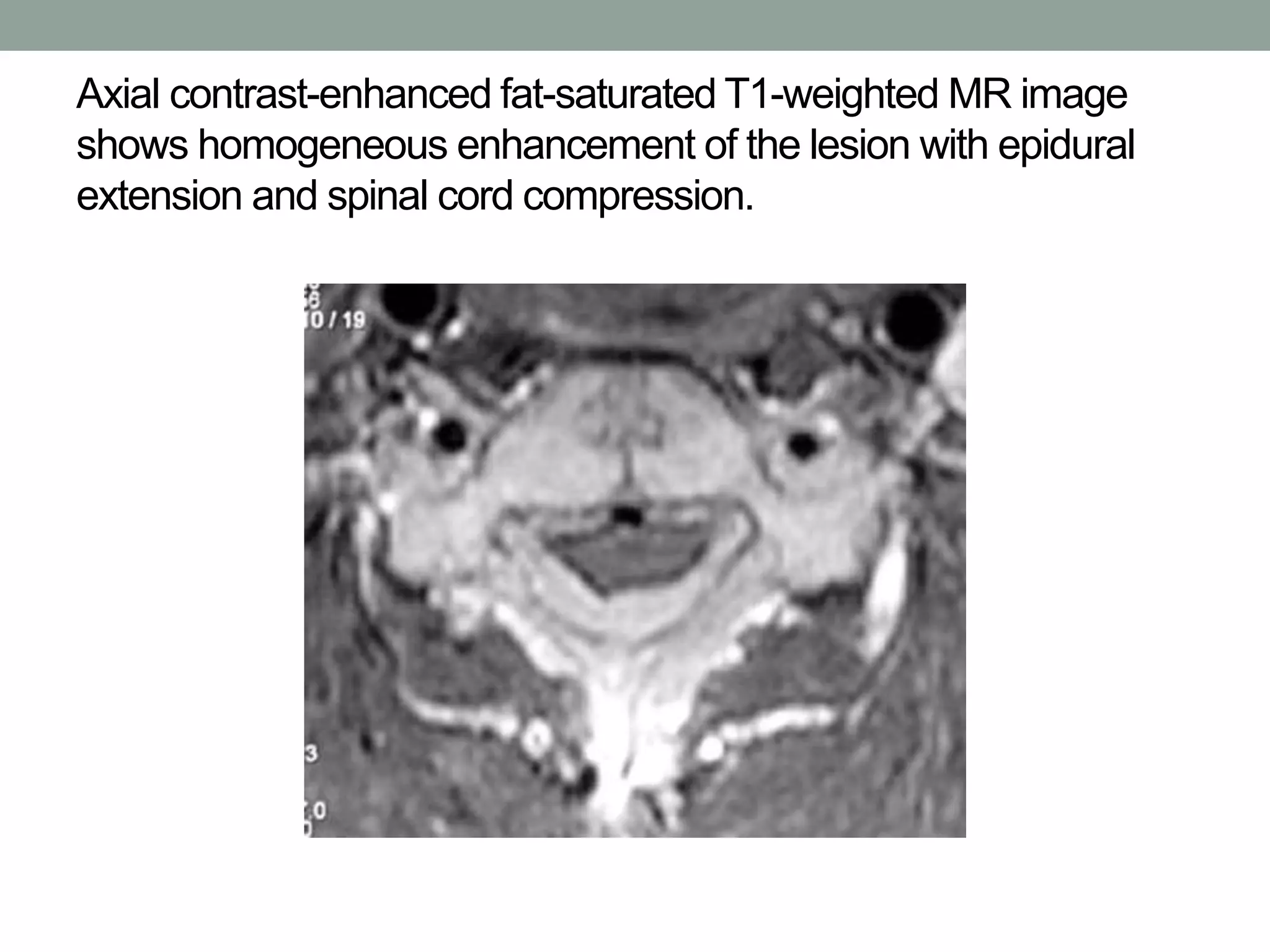Axial contrast-enhanced fat-saturated T1-weighted MR image
shows homogeneous enhancement of the lesion with epidural
extension and spinal cord compression.
 