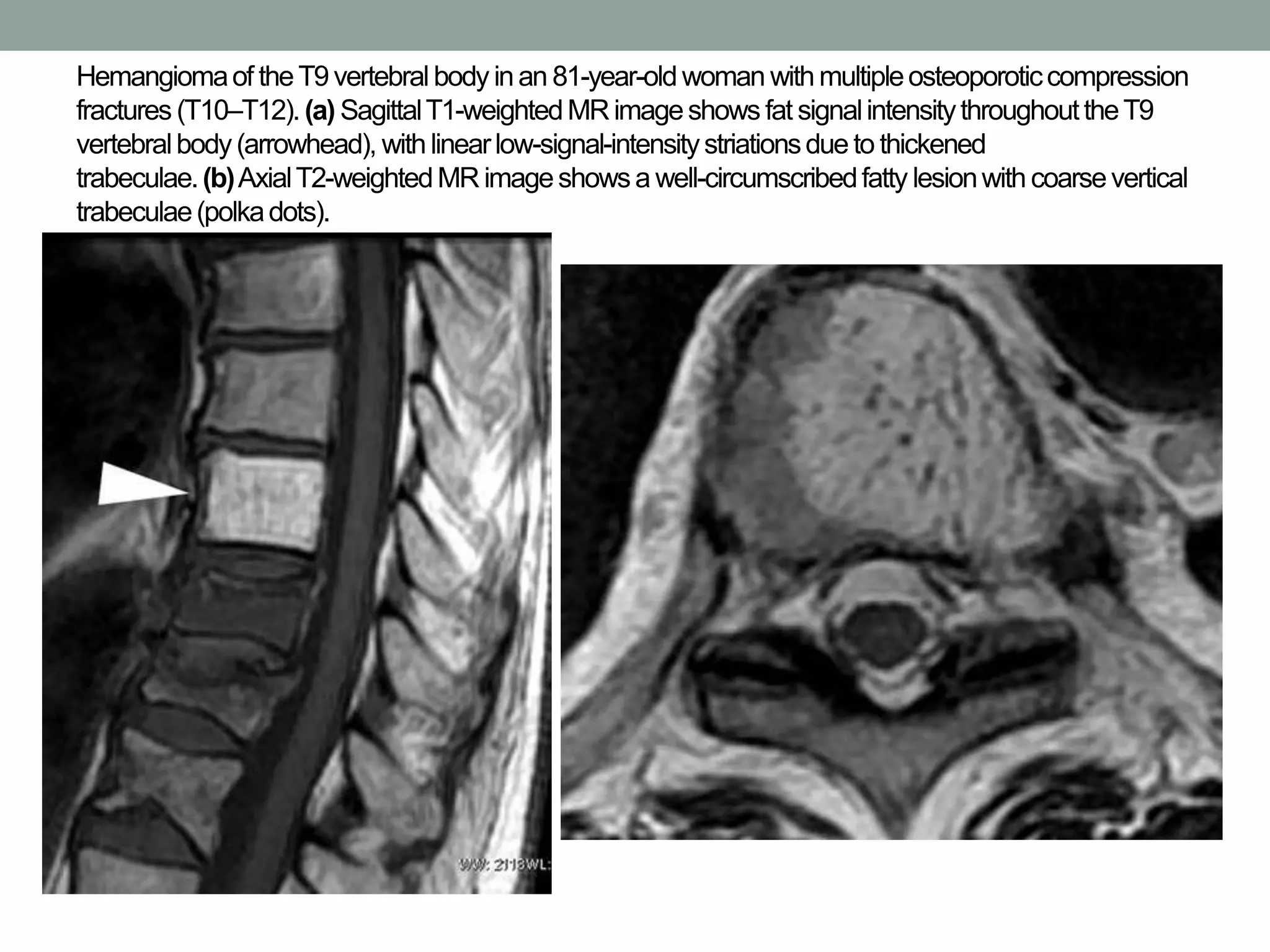 Hemangiomaof theT9vertebralbody inan 81-year-oldwoman withmultipleosteoporoticcompression
fractures (T10–T12). (a) SagittalT1-weightedMR imageshows fat signalintensitythroughouttheT9
vertebralbody(arrowhead), with linearlow-signal-intensitystriationsdue to thickened
trabeculae.(b)AxialT2-weightedMR imageshowsa well-circumscribedfatty lesionwith coarsevertical
trabeculae(polkadots).
 