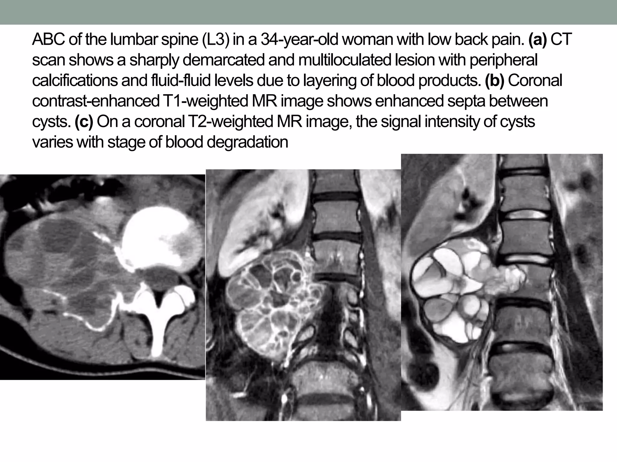 ABC of the lumbar spine (L3) in a 34-year-old woman with low back pain. (a) CT
scan shows a sharply demarcated and multiloculated lesion with peripheral
calcifications and fluid-fluid levels due to layering of blood products.(b) Coronal
contrast-enhancedT1-weighted MR image shows enhanced septa between
cysts. (c) On a coronalT2-weighted MR image, the signal intensity of cysts
varies with stage of blood degradation
 