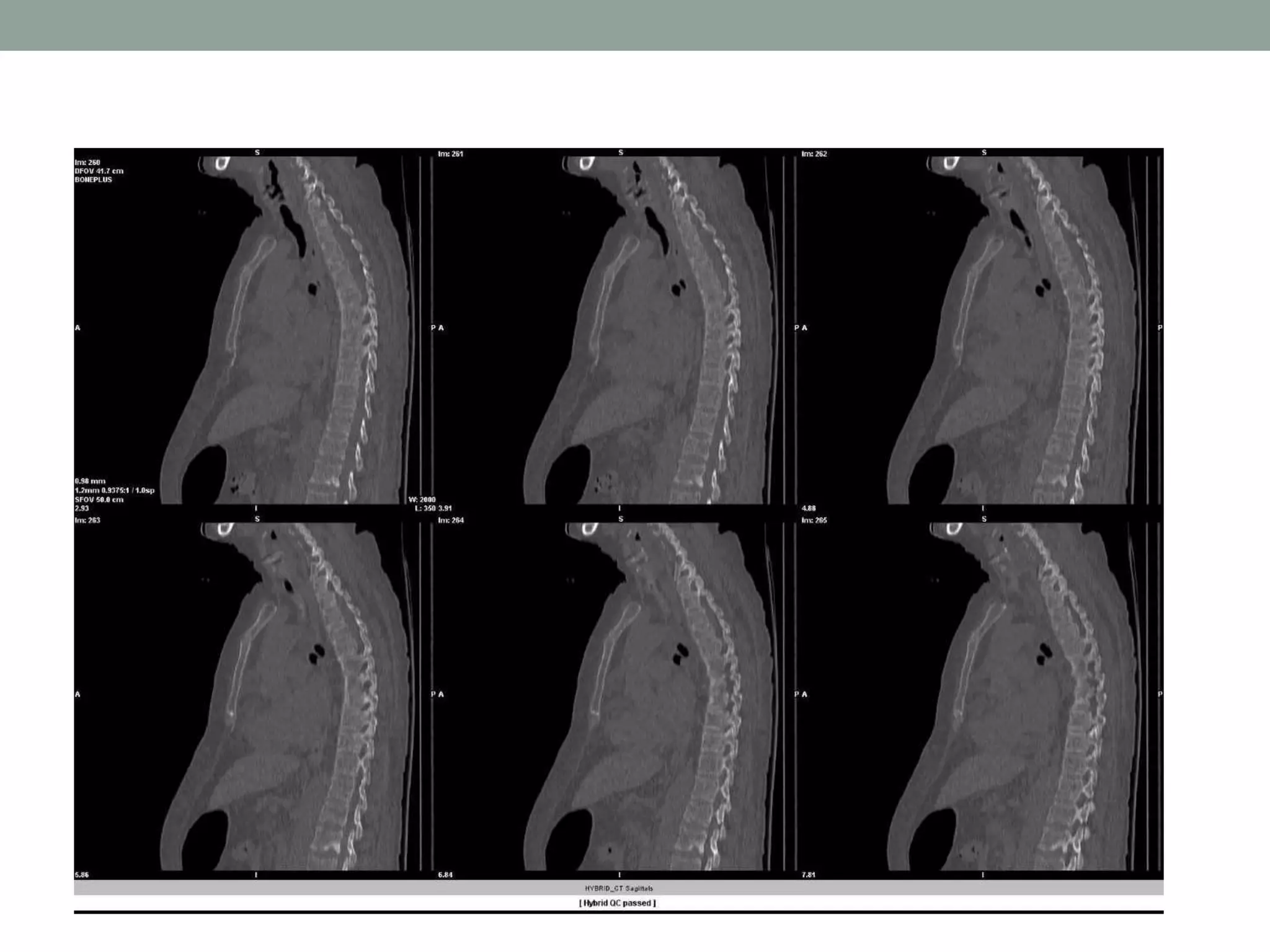 Primary bone tumors of the spine