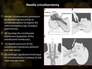 Cricothyrotomy
 Palate thyroid cartilage-inferior to the mandible & hyoid
bone in the midline
 Cricoid cartilage – 2 to ...
