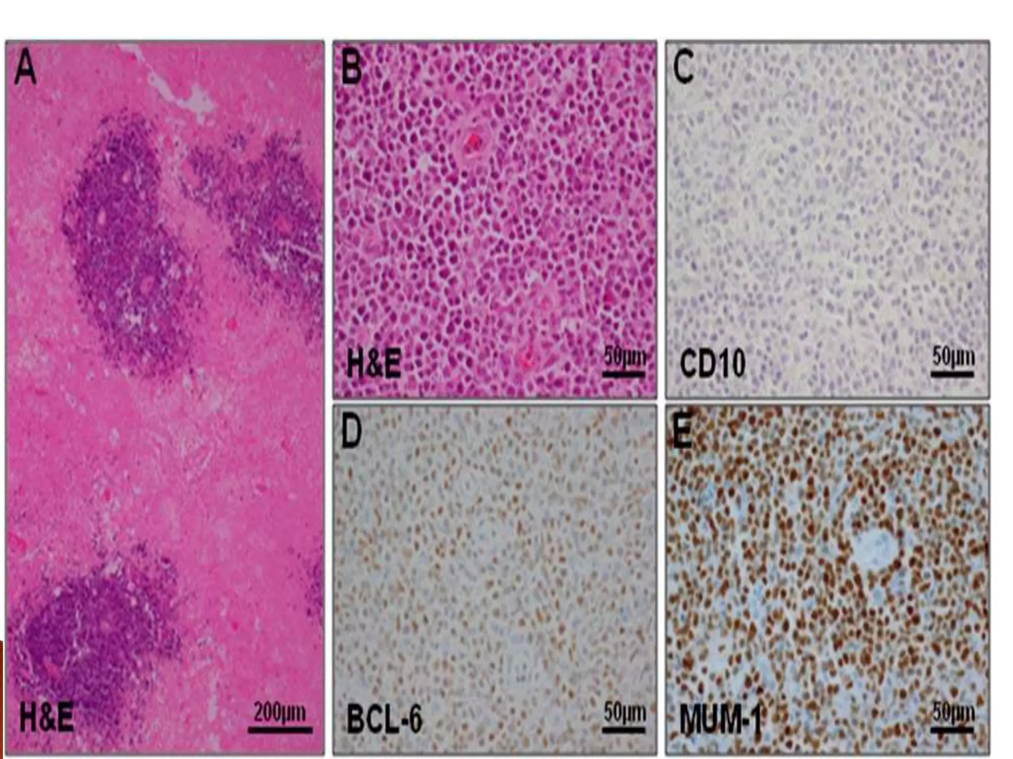 Primary CNS lymphoma | PPTX