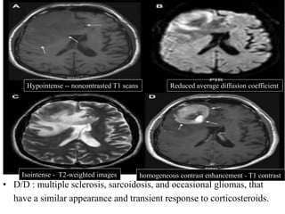 • D/D : multiple sclerosis, sarcoidosis, and occasional gliomas, that
have a similar appearance and transient response to corticosteroids.
Hypointense -- noncontrasted T1 scans
Isointense - T2-weighted images homogeneous contrast enhancement - T1 contrast
Reduced average diffusion coefficient
 