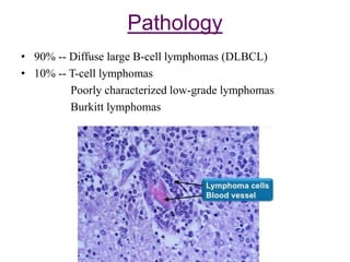Pathology
• 90% -- Diffuse large B-cell lymphomas (DLBCL)
• 10% -- T-cell lymphomas
Poorly characterized low-grade lymphomas
Burkitt lymphomas
 