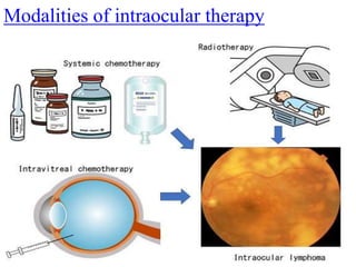 Modalities of intraocular therapy
 