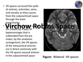 Figure: Bilateral VR spaces
• VR spaces surround the walls
of arteries, arterioles, veins,
and venules as they course
from the subarachnoid space
through the brain
parenchyma
• Arteries in the cerebral cortex
are coated by a layer of
leptomeninges that is
subtended from the pia
mater; by this anatomic
arrangement, the VR spaces
of the intracortical arteries
are in direct continuity with
the VR spaces around arteries
in the subarachnoid space
Virchow Robins Space
 