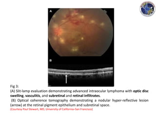 Fig 3:
(A) Slit-lamp evaluation demonstrating advanced intraocular lymphoma with optic disc
swelling, vasculitis, and subretinal and retinal infiltrates.
(B) Optical coherence tomography demonstrating a nodular hyper-reflective lesion
(arrow) at the retinal pigment epithelium and subretinal space.
(Courtesy Paul Stewart, MD, University of California–San Francisco)
 