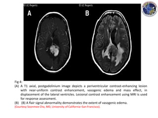 Fig 4:
(A) A T1 axial, postgadolinium image depicts a periventricular contrast-enhancing lesion
with near-uniform contrast enhancement, vasogenic edema and mass effect, in
displacement of the lateral ventricles. Lesional contrast enhancement using MRI is used
for response assessment.
(B) (B) A flair signal abnormality demonstrates the extent of vasogenic edema.
(Courtesy Soonmee Cha, MD, University of California–San Francisco).
 