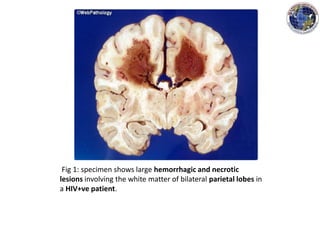 Fig 1: specimen shows large hemorrhagic and necrotic
lesions involving the white matter of bilateral parietal lobes in
a HIV+ve patient.
 