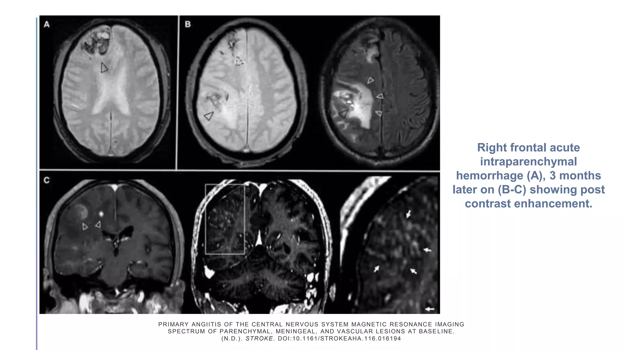 Primary cns vasculitis | PPTX