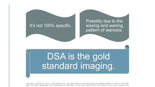 DSA is the gold
standard imaging.
It’s not 100% specific.
Possibly due to the
waxing and waning
pattern of stenosis.
VALERIE L JEWELLS. (N.D.). CNS VASCULITIS; AN OVERVIEW OF THIS M ULTIPLE SCLEROSIS MIMIC; CLINICAL AND MRI
IMPLICATIONS. SEMINARS IN ULTRASOUND CT AND MRI. HTTPS://DOI.ORG /HTTPS://DOI.ORG/10.1053/J.SULT.2020.02.004
 