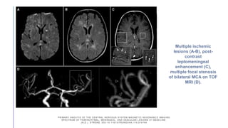 PRIMARY ANGIITIS OF THE CENTRAL NERVOUS SYSTEM MAGNETIC RESONANC E IMAGING
SPECTRUM OF PARENCHYMAL, MENINGEAL, AND VASCULAR LESIONS AT BASE LINE.
(N.D.). STROKE. DOI:10.1161/STROKEAHA.116.016194
Multiple ischemic
lesions (A-B), post-
contrast
leptomeningeal
enhancement (C),
multiple focal stenosis
of bilateral MCA on TOF
MRI (D).
 