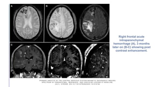 PRIMARY ANGIITIS OF THE CENTRAL NERVOUS SYSTEM MAGNETIC RESONANC E IMAGING
SPECTRUM OF PARENCHYMAL, MENINGEAL, AND VASCULAR LESIONS AT BASE LINE.
(N.D.). STROKE. DOI:10.1161/STROKEAHA.116.016194
Right frontal acute
intraparenchymal
hemorrhage (A), 3 months
later on (B-C) showing post
contrast enhancement.
 