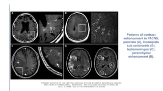PRIMARY ANGIITIS OF THE CENTRAL NERVOUS SYSTEM MAGNETIC RESONANC E IMAGING
SPECTRUM OF PARENCHYMAL, MENINGEAL, AND VASCULAR LESIONS AT BASE LINE.
(N.D.). STROKE. DOI:10.1161/STROKEAHA.116.016194
Patterns of contrast
enhancement in PACNS,
punctate (A), incomplete
sub centimetric (B),
leptomeningeal (C),
parenchymal
enhancement (D).
 