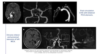PRIMARY ANGIITIS OF THE CENTRAL NERVOUS SYSTEM MAGNETIC RESONANC E IMAGING
SPECTRUM OF PARENCHYMAL, MENINGEAL, AND VASCULAR LESIONS AT BASE LINE.
(N.D.). STROKE. DOI:10.1161/STROKEAHA.116.016194
Post circulation
CVS with bilateral
PCA stenosis.
Chronic infarct
and proximal
stenosis of left
MCA.
 
