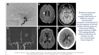 Multifocal segmental
narrowing (A),
multiple DWI lesions in
different vascular
territories(B),
concentric enhancement of
the M1-segment of the left
middle cerebral artery on
black blood MRI(C),
vessel beading on MRI-
TOF-angiography(D),
bilateral infarctions of
variable size (E),
and intracerebral
hemorrhage (F).
CAROLIN BEUKE. (N.D.). PRIMARY ANGIITIS OF THE CENTRAL NERVOUS SYSTEM: DIAGNOSIS AND TREATMENT.
THER ADV NEUROL DISORD. HTTPS://DOI.ORG/ 10.1177/1756286418785071
 