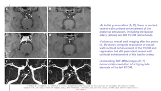 -At initial presentation (A, C), there is marked
vessel wall contrast enhancement of the
posterior circulation, including the basilar
artery (arrow) and left PCOM (arrowhead).
-Follow-up vessel wall imaging after ten years
(B, D) shows complete resolution of vessel
wall contrast enhancement of the PCOM and
regressive but still persistent vessel wall
contrast enhancement of the basilar artery.
-Correlating TOF-MRA images (E, F)
demonstrate resolution of a high-grade
stenosis of the left PCOM.
PATZIG, M., FORBRIG, R., KÜPPER, C. ET AL. DIAGNOSIS AND FOLLOW-UP EVALUATION OF CENTRAL NERVOUS SYSTEM
VASCULITIS: AN EVALUATION OF VESSEL-WALL MRI FINDINGS. J NEUROL 269, 982–996 (2022). HTTPS://DOI.ORG/10.1007/S00415-
021-10683-7
 