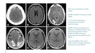 A-CT scan showing a small
cSAH,
B-MRI (FLAIR) showing a small
cSAH,
C- CT scan showing an
occipital intracerebral
haemorrhage,
D-MRI showing sequelae of
bilateral occipital infarcts and
left frontal-parietal infarct,
E-MRI (FLAIR) showing
hypersignals consistent with a
RPLS,
F-Control MRI in the same
patient after 28 days showing
resolution of the RPLS.
 