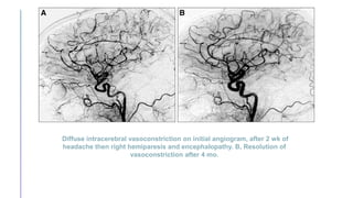 Diffuse intracerebral vasoconstriction on initial angiogram, after 2 wk of
headache then right hemiparesis and encephalopathy. B, Resolution of
vasoconstriction after 4 mo.
 