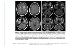 ALIAGA FREDERIK BARKHOF, E. S. (N.D.). CHAPTER 13 - MRI MIMICS OF MULTIPLE SCLEROSIS. IN HANDBOOK OF
CLINICAL NEUROLOGY (PP. 291–316). ELSEVIER.
 