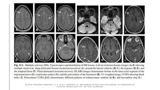ALIAGA FREDERIK BARKHOF, E. S. (N.D.). CHAPTER 13 - MRI MIMICS OF MULTIPLE SCLEROSIS. IN HANDBOOK OF
CLINICAL NEUROLOGY (PP. 291–316). ELSEVIER.
 