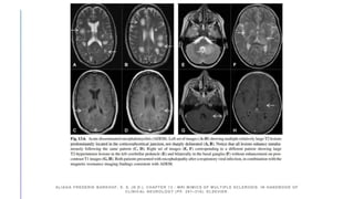 ALIAGA FREDERIK BARKHOF, E. S. (N.D.). CHAPTER 13 - MRI MIMICS OF MULTIPLE SCLEROSIS. IN HANDBOOK OF
CLINICAL NEUROLOGY (PP. 291–316). ELSEVIER.
 