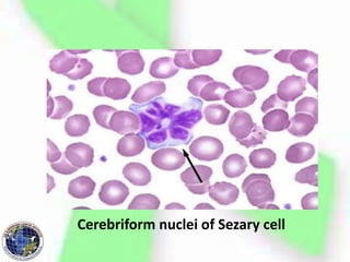 Cerebriform nuclei of Sezary cell
 