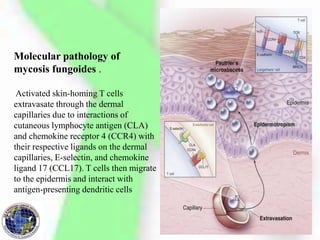 Molecular pathology of
mycosis fungoides .
Activated skin-homing T cells
extravasate through the dermal
capillaries due to interactions of
cutaneous lymphocyte antigen (CLA)
and chemokine receptor 4 (CCR4) with
their respective ligands on the dermal
capillaries, E-selectin, and chemokine
ligand 17 (CCL17). T cells then migrate
to the epidermis and interact with
antigen-presenting dendritic cells
 