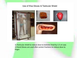 1) Testicular shield to reduce dose to testicles lined by 1.5 cm wax
2) Hand Gloves are used after certain fractions to reduce dose to
finger.
 