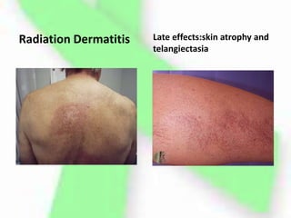 Radiation Dermatitis Late effects:skin atrophy and
telangiectasia
 