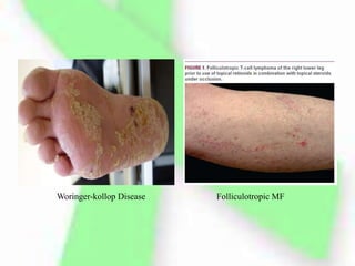Woringer-kollop Disease Folliculotropic MF
 