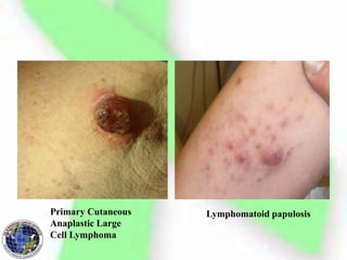 Primary Cutaneous
Anaplastic Large
Cell Lymphoma
Lymphomatoid papulosis
 