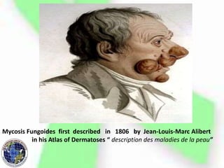 Mycosis Fungoides first described in 1806 by Jean-Louis-Marc Alibert
in his Atlas of Dermatoses “ description des maladies de la peau”
 