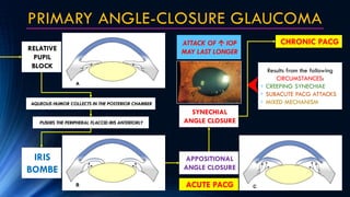 PRIMARY ANGLE-CLOSURE GLAUCOMA
RELATIVE
PUPIL
BLOCK
AQUEOUS HUMOR COLLECTS IN THE POSTERIOR CHAMBER
PUSHES THE PERIPHERAL ...