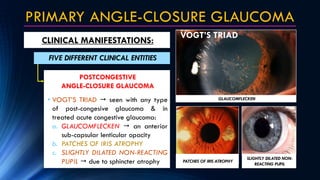 PRIMARY ANGLE-CLOSURE GLAUCOMA
CLINICAL MANIFESTATIONS:
FIVE DIFFERENT CLINICAL ENTITIES
POSTCONGESTIVE
ANGLE-CLOSURE GLAU...