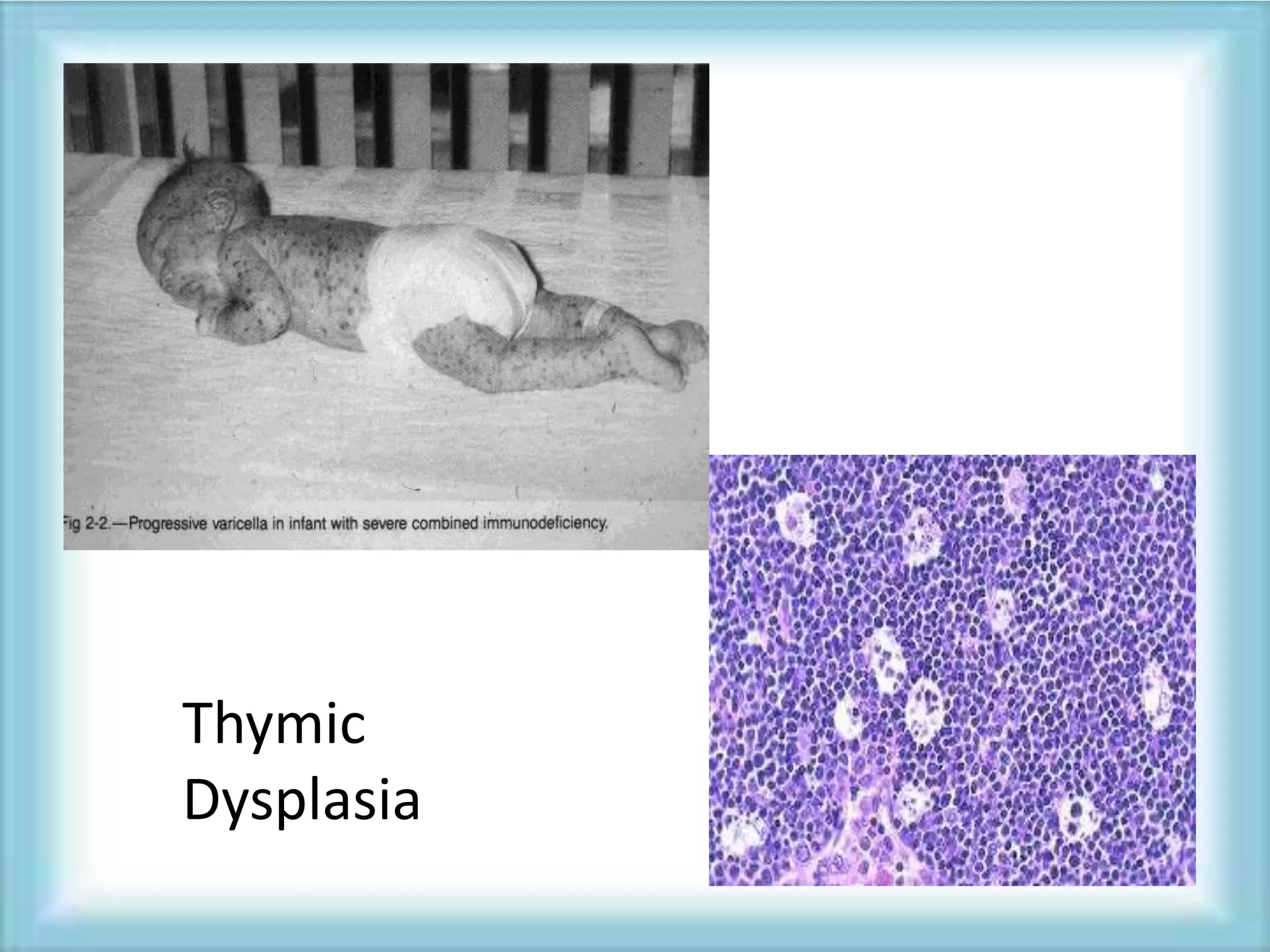 Thymic
Dysplasia
 