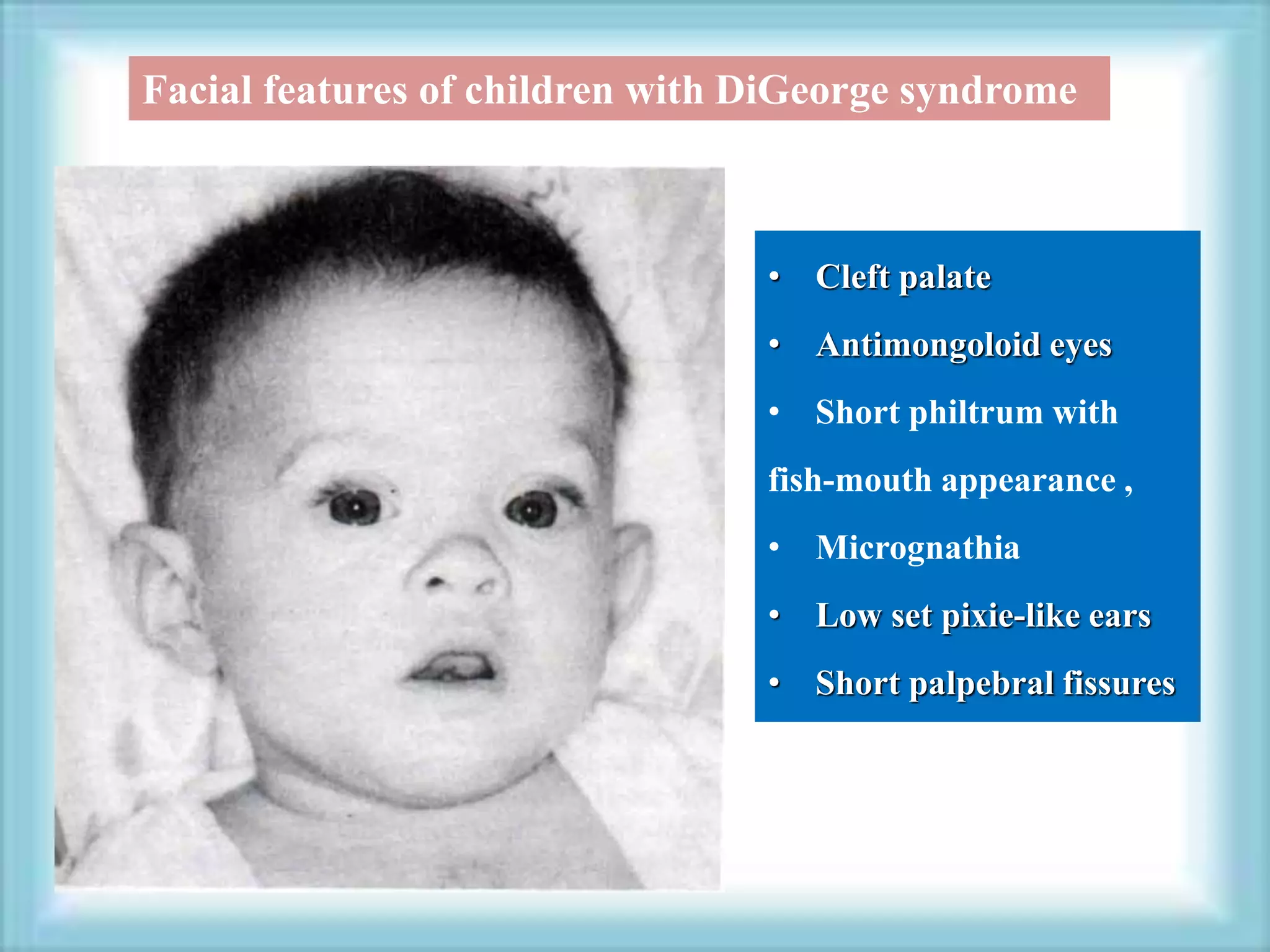 • Cleft palate
• Antimongoloid eyes
• Short philtrum with
fish-mouth appearance ,
• Micrognathia
• Low set pixie-like ears
• Short palpebral fissures
Facial features of children with DiGeorge syndrome
 