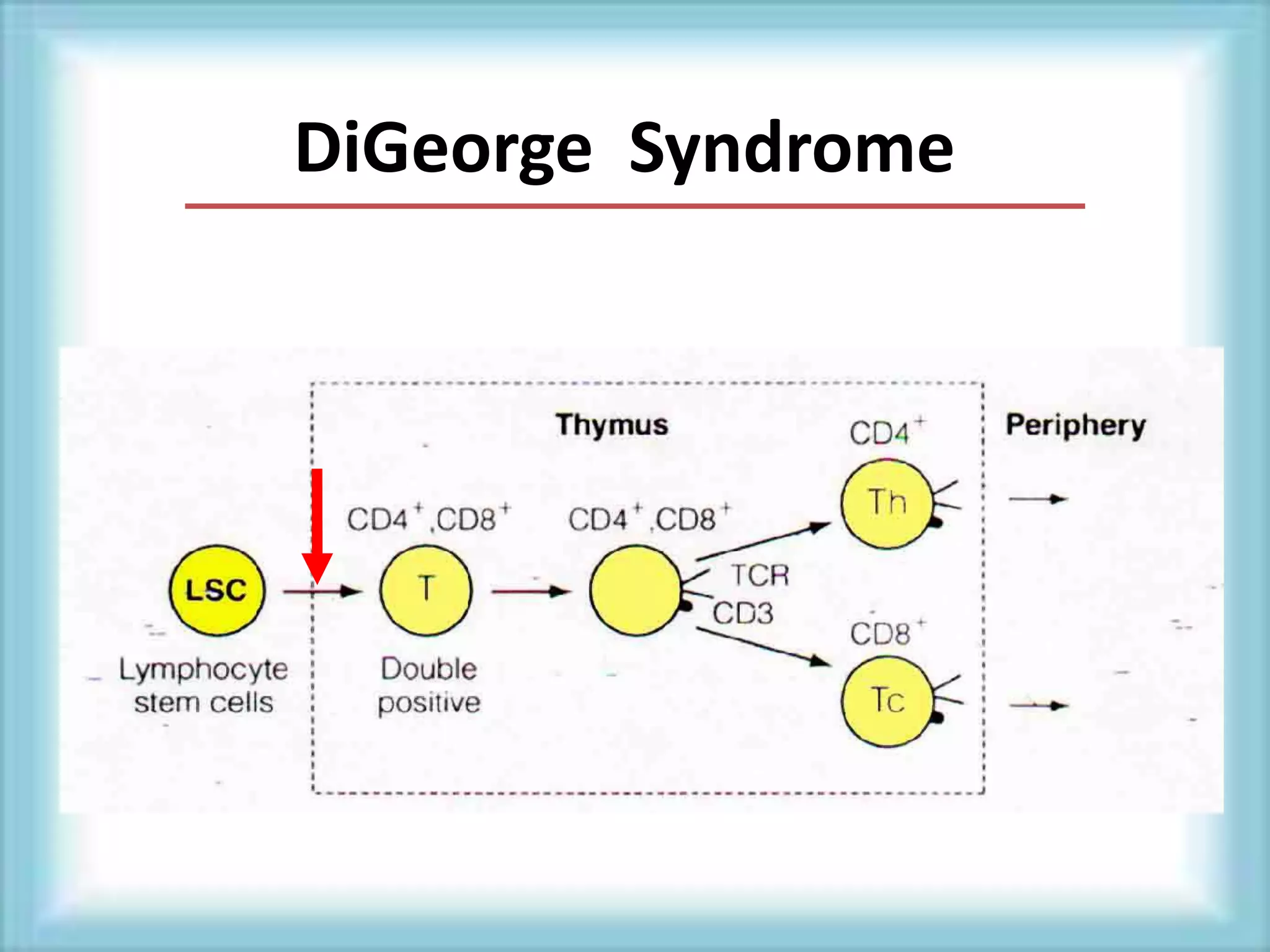 DiGeorge Syndrome
 