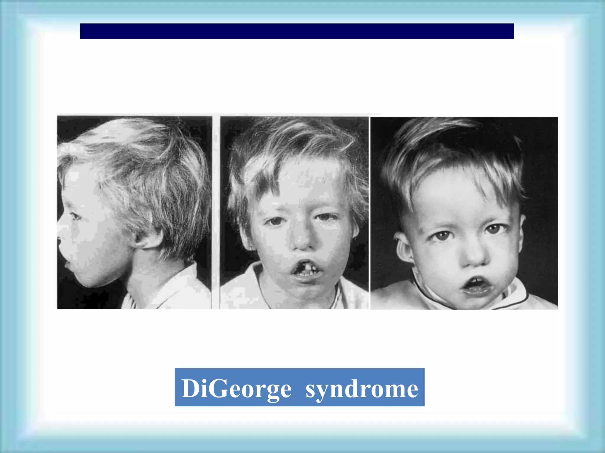 DiGeorge syndrome
 