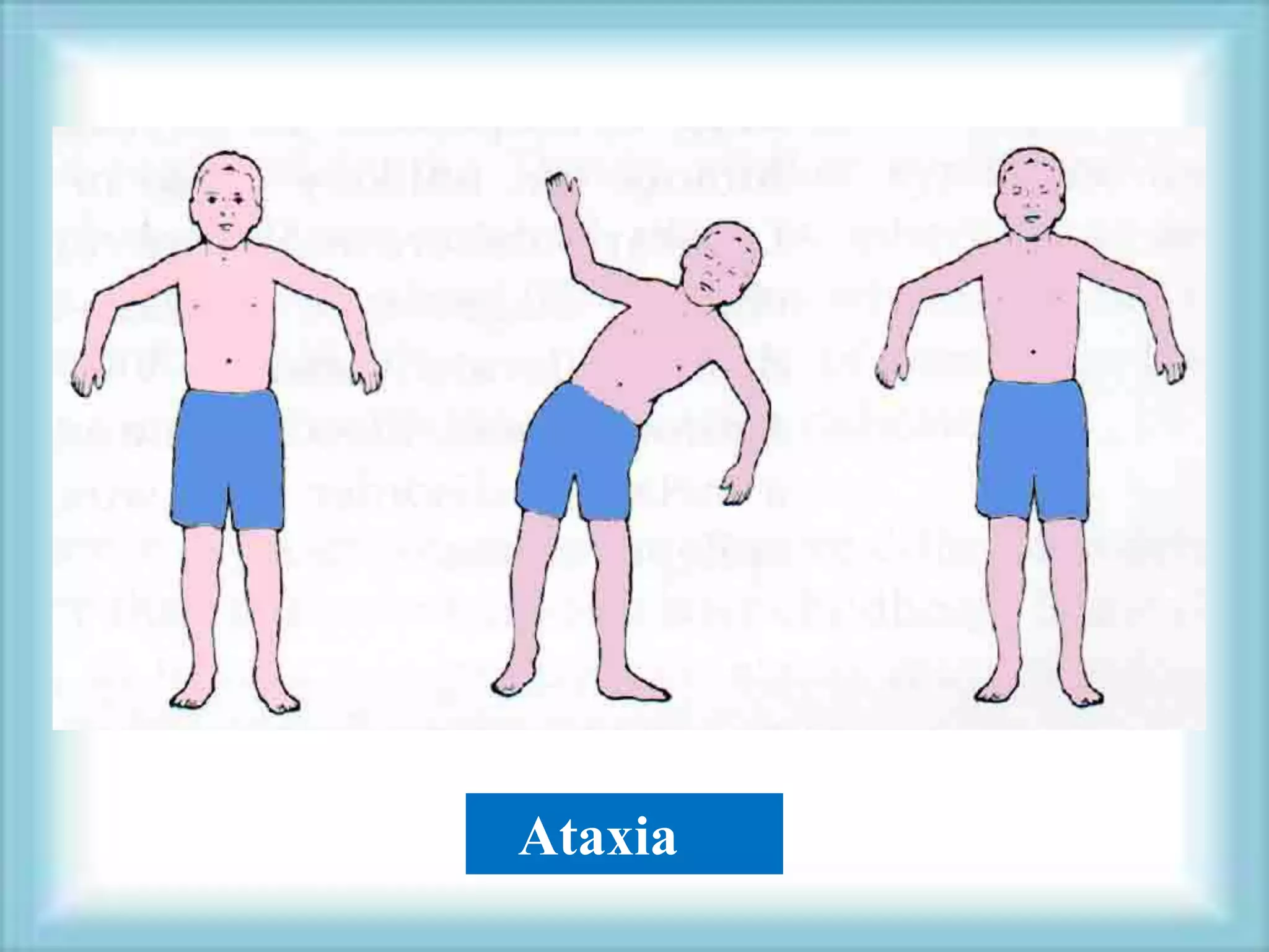 Ataxia
 