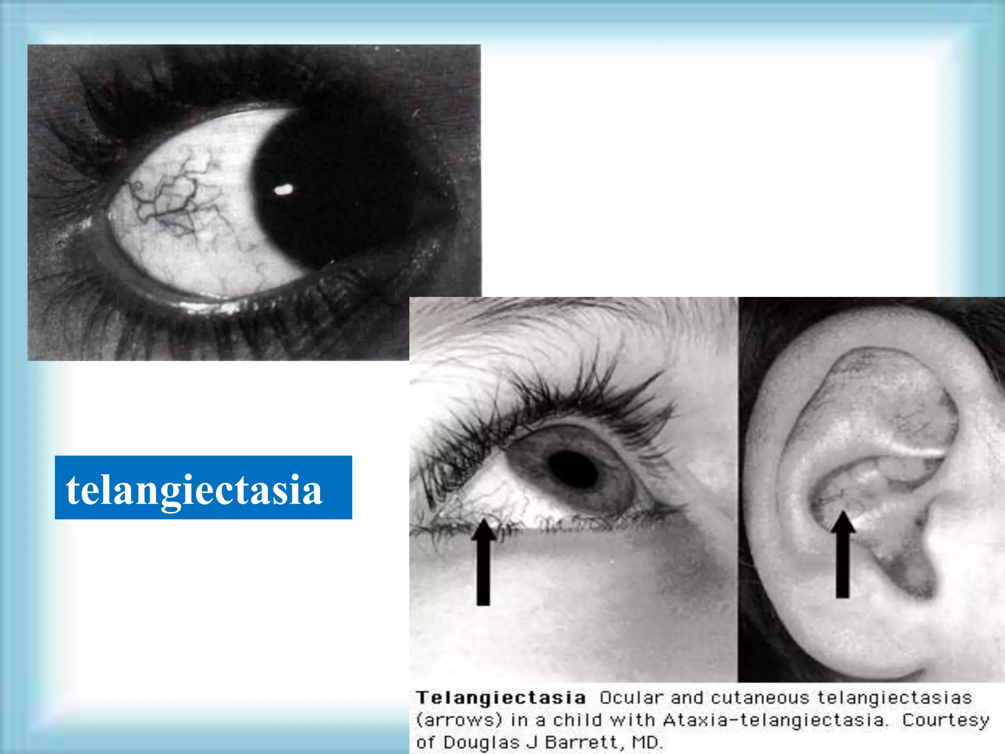 telangiectasia
 