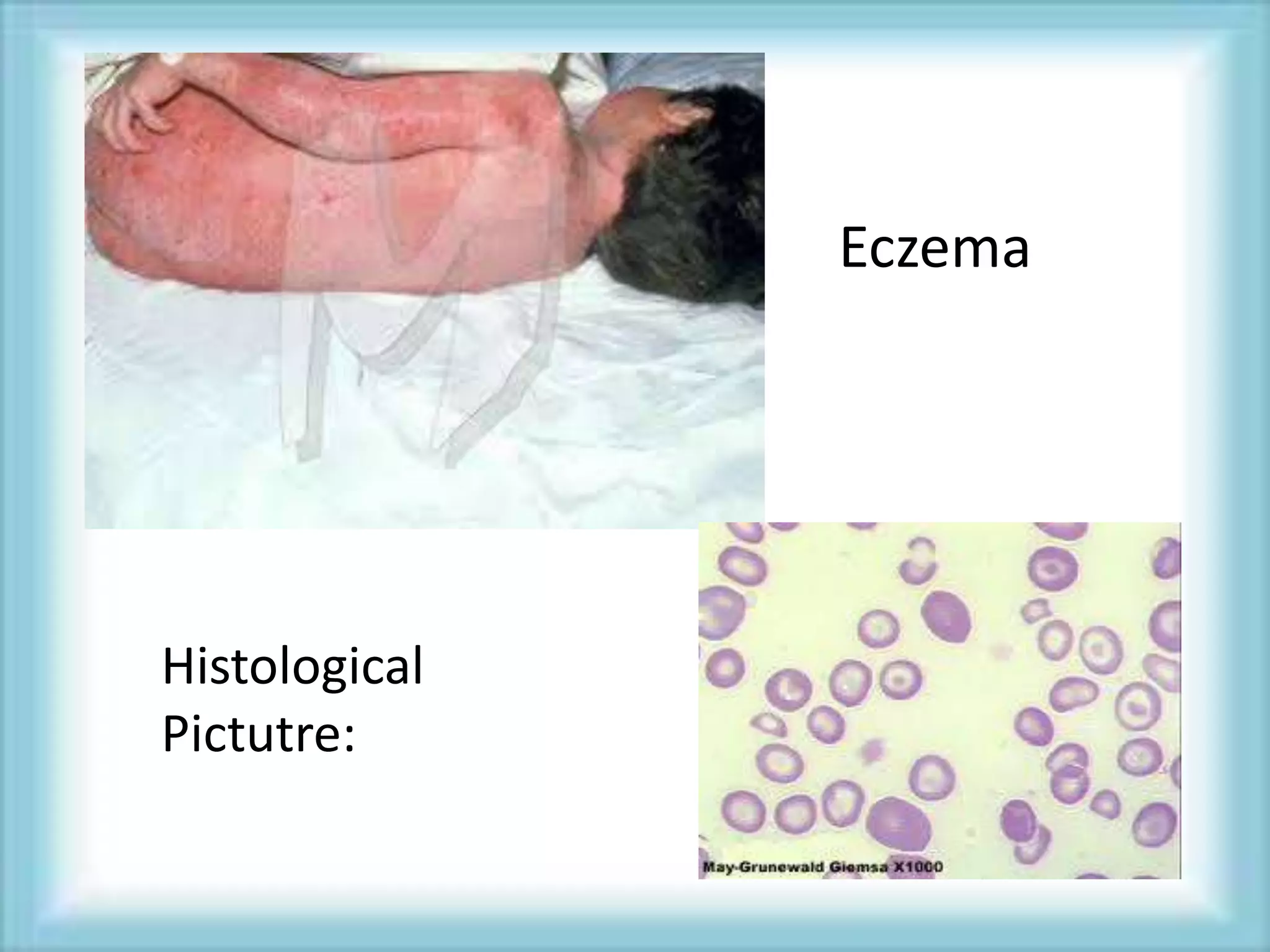 Eczema
Histological
Pictutre:
 