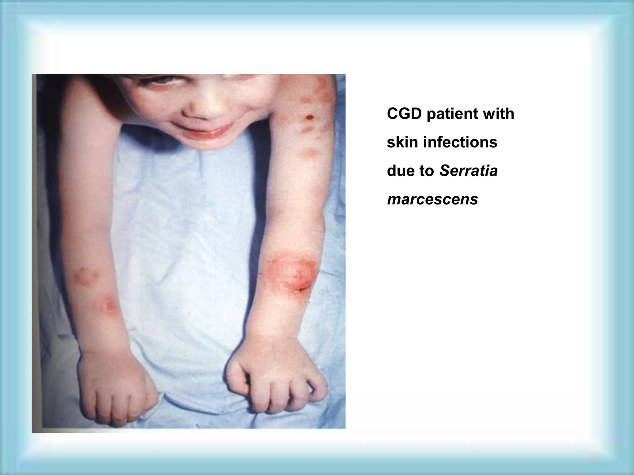 CGD patient with
skin infections
due to Serratia
marcescens
 